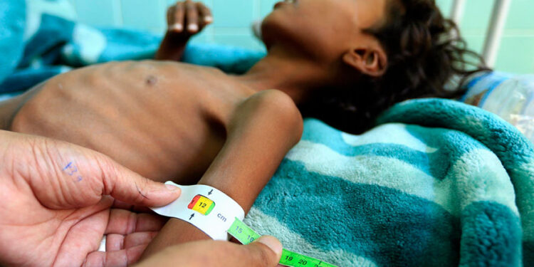 Desnutrición infantil en Yemen. Foto Unicef.
