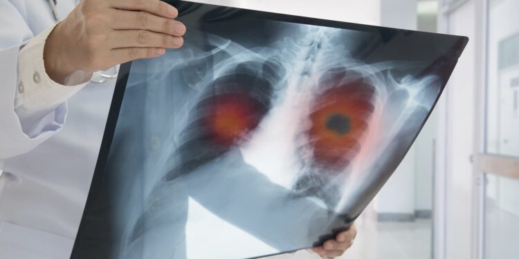 Tomografía pulmón. Foto agencias.
