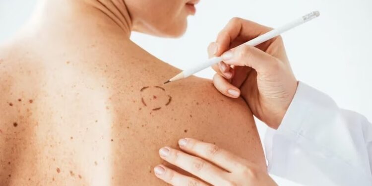 Detectado a tiempo, el cáncer de piel es curable en la mayoría de los casos (Shutterstock)