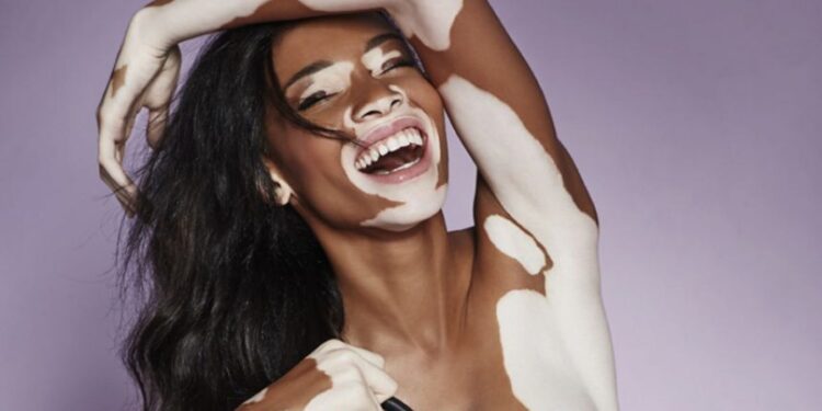 Chantelle Brown-Young, más conocida como Winnie Harlow, es una modelo canadiense-Jamaiquina y portavoz de la enfermedad de la piel llamada vitíligo. Saltó a la fama como concursante del ciclo 21 del programa de televisión estadounidense America's Next Top Model.